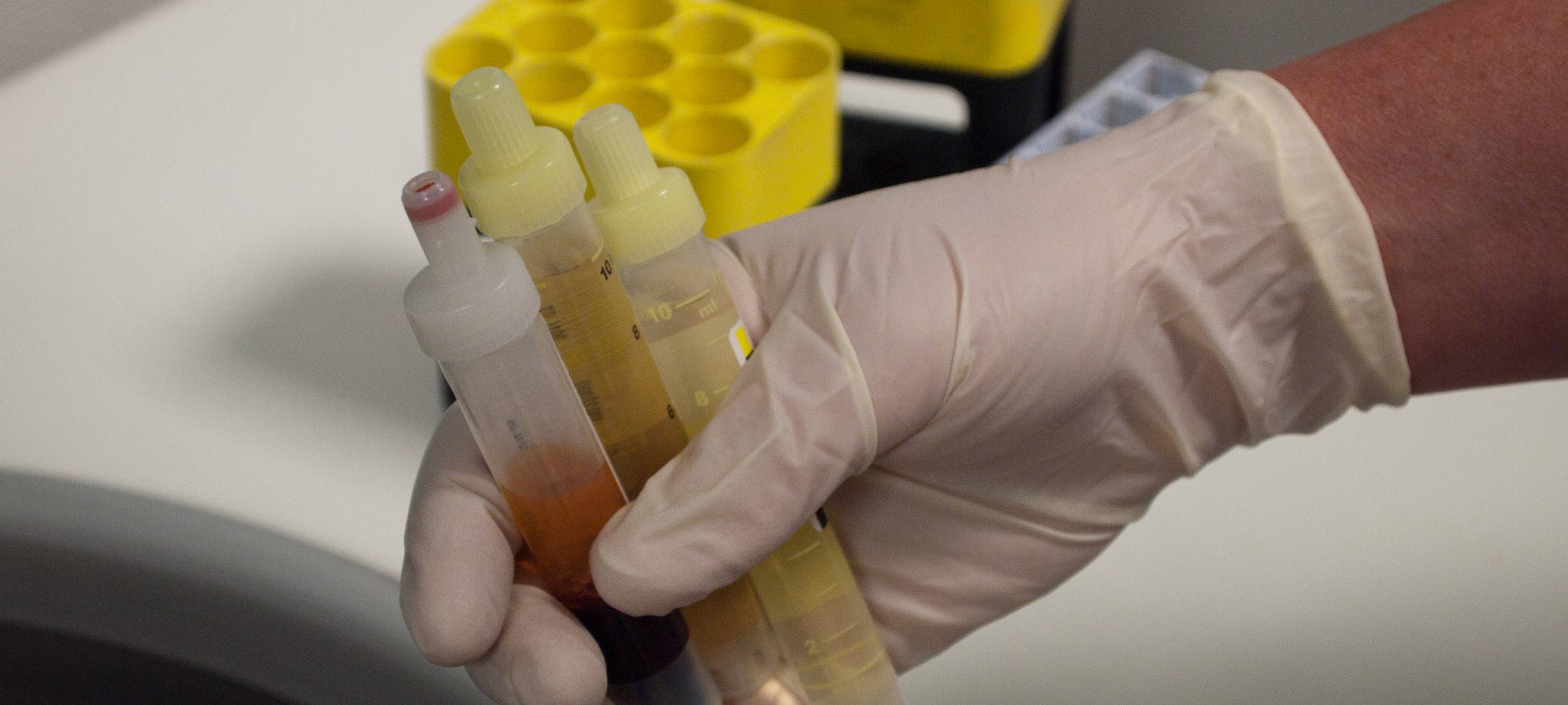 Vier bestätigte Corona-Fälle in Remscheid