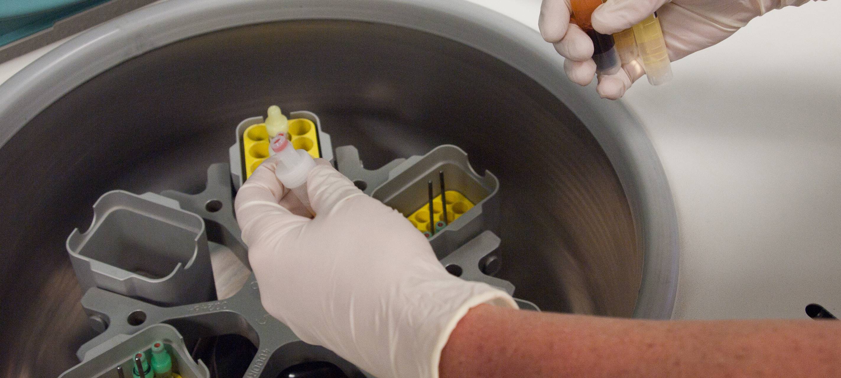 Corona-Fälle in Solingen: Erste Ergebnisse der Reihentests