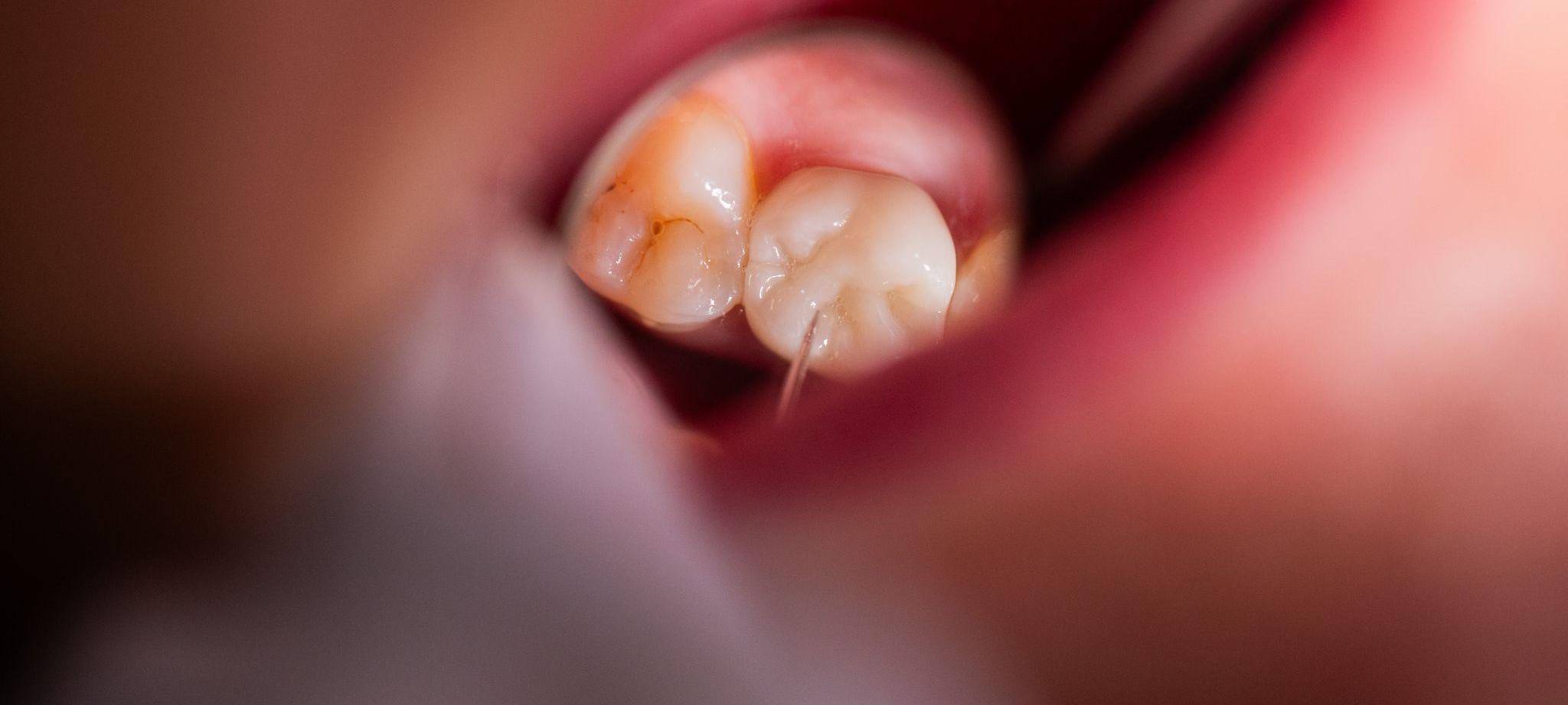 Zahnarzt schaut sich Zirkon-Vollkeramikkrone einer Patientin an